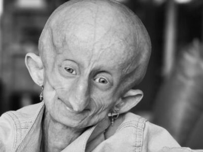 Fallece Beandri Booysen, la joven influencer sudafricana que inspiró al mundo con su lucha contra la progeria