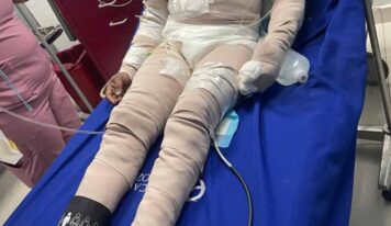 Hombre quemado por su pareja muere en Santo Domingo