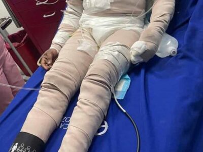 Hombre quemado por su pareja muere en Santo Domingo