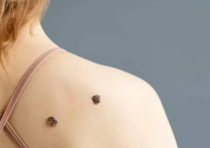 Estudio confirma que las camas de bronceado aumentan el riesgo de cáncer de piel