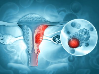Día Mundial del Cáncer de Ovario: un llamado a la prevención y al diagnóstico temprano