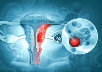 Día Mundial del Cáncer de Ovario: un llamado a la prevención y al diagnóstico temprano