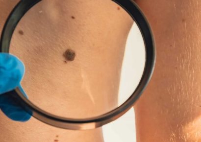 Cuba desarrolla candidato 2C12 contra melanomas avanzados