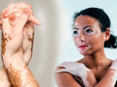 Emiratos aprueba el primer medicamento oral contra el vitiligo