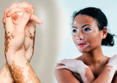 Emiratos aprueba el primer medicamento oral contra el vitiligo