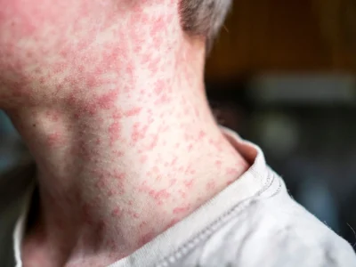 OPS alerta por récord de casos de sarampión en América