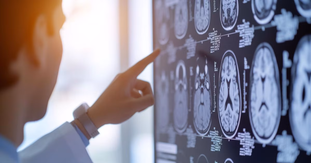 Nuevo mapa cerebral abre la puerta a tratamientos más precisos contra la epilepsia